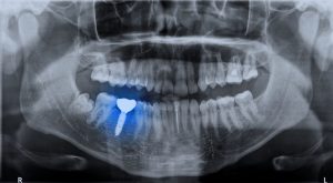 implantu zębowego 