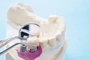 implantów zębowych